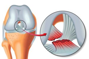 Chirurgie du ligament du genou